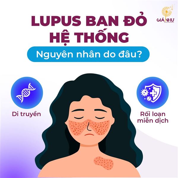 Những điều cần biết về Lupus 