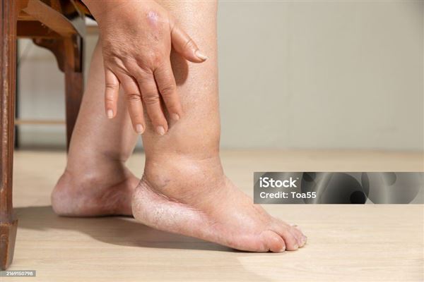 Những điều cần biết về bệnh Thận mạn