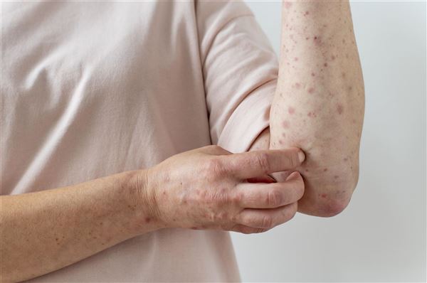 Lupus ban đỏ hệ thống