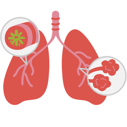 Bệnh phổi tắc nghẽn mãn tính (COPD)